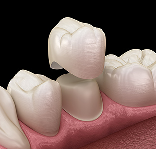 Prosthodontic Treatment