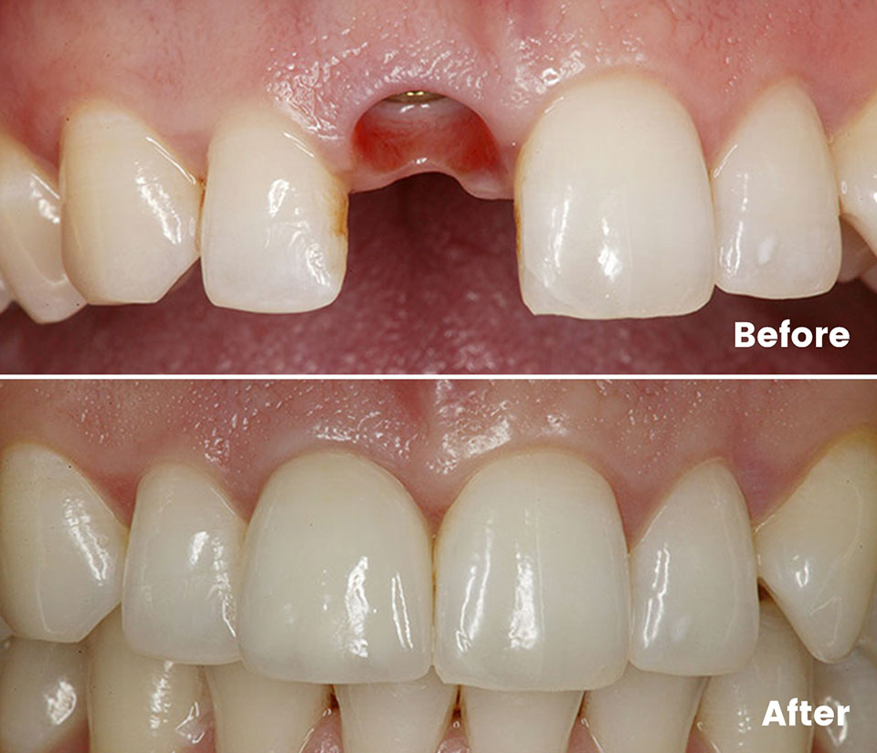 dental implants front teeth